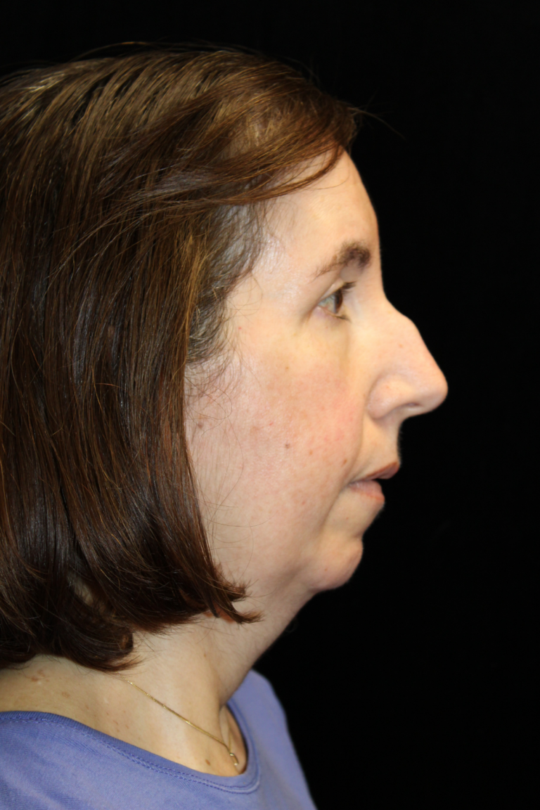 Before Image: Preservation Septo-Rhinoplasty - right-side