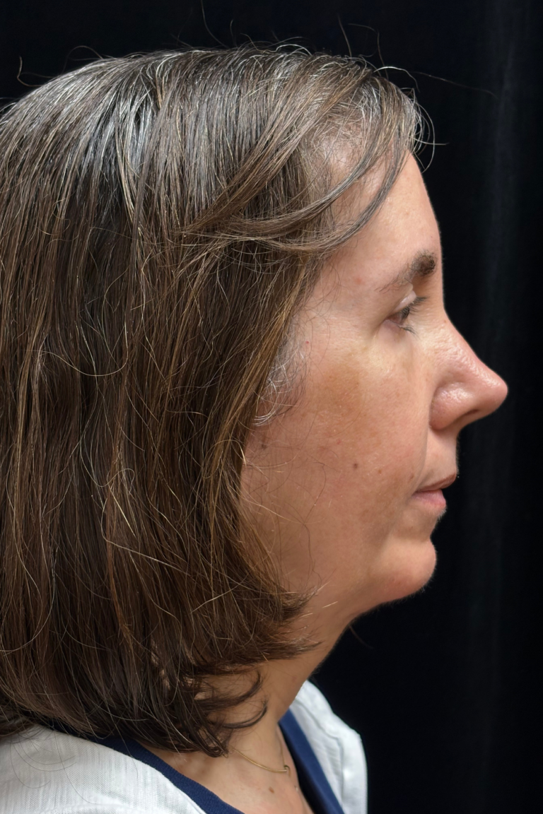 After Image: Preservation Septo-Rhinoplasty - right-side