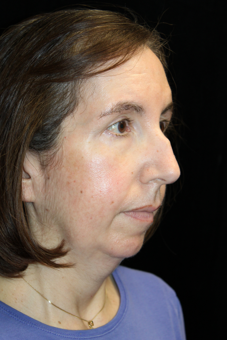 Before Image: Preservation Septo-Rhinoplasty - right-front-oblique