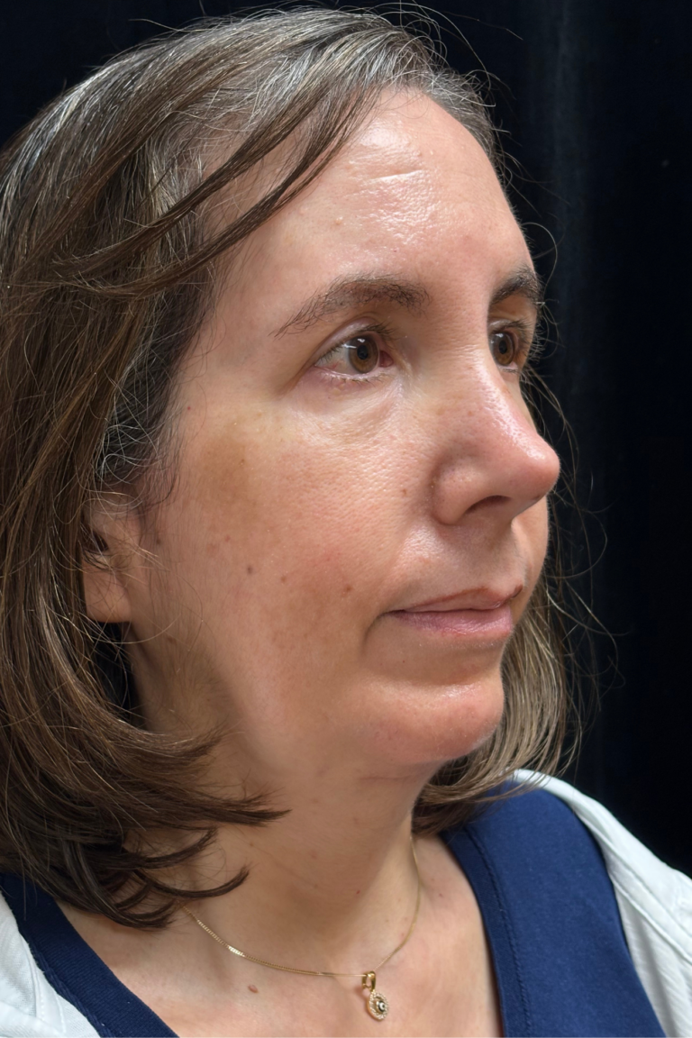 After Image: Preservation Septo-Rhinoplasty - right-front-oblique