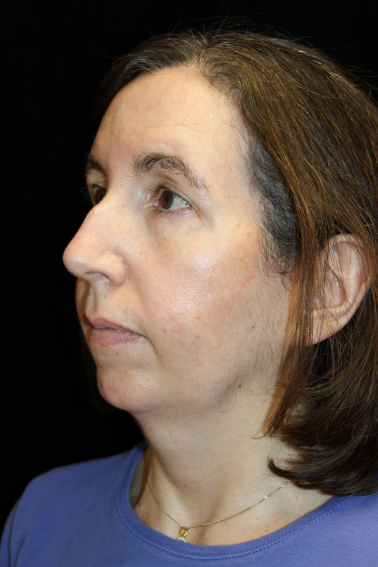 Before Image: Preservation Septo-Rhinoplasty - left-front-oblique