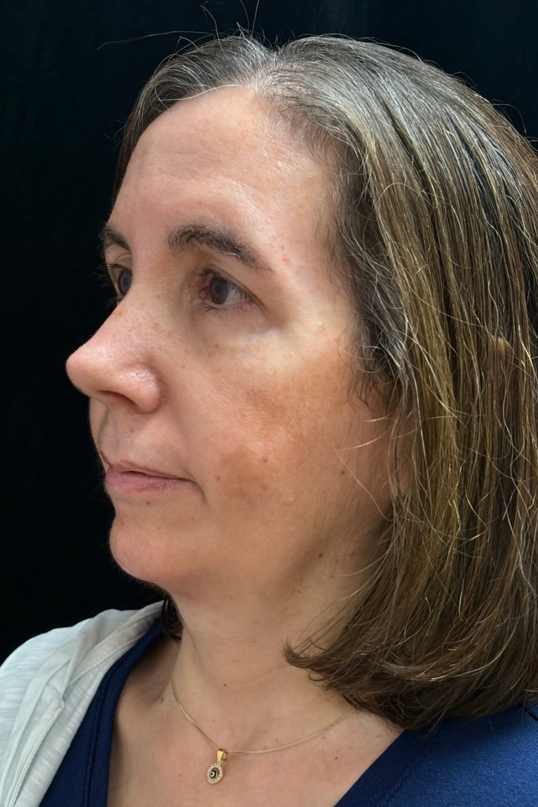 After Image: Preservation Septo-Rhinoplasty - left-front-oblique