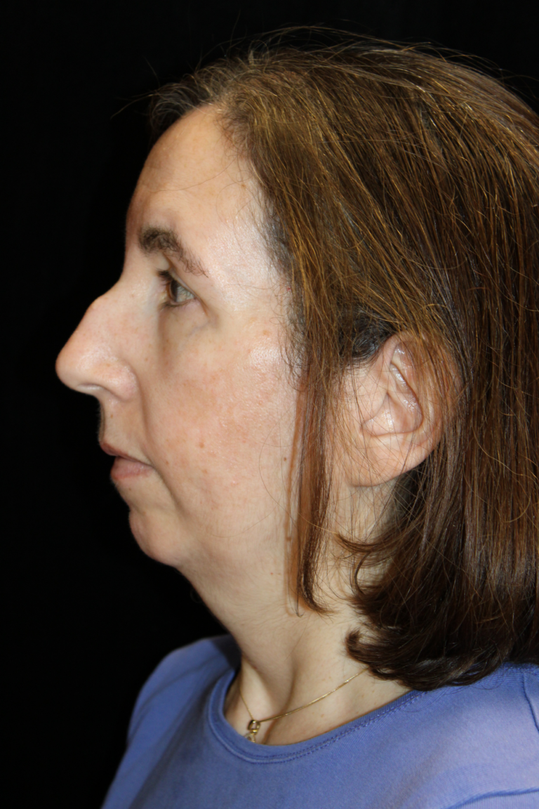 Before Image: Preservation Septo-Rhinoplasty - left-side