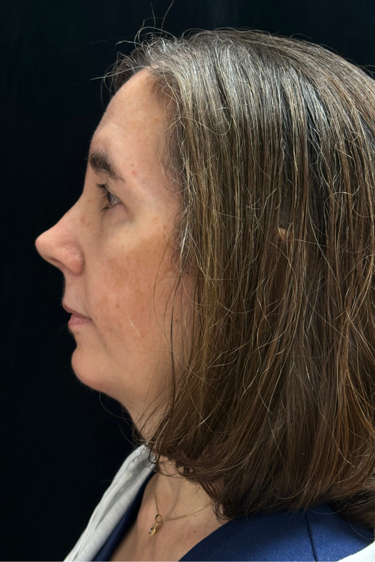After Image: Preservation Septo-Rhinoplasty - left-side