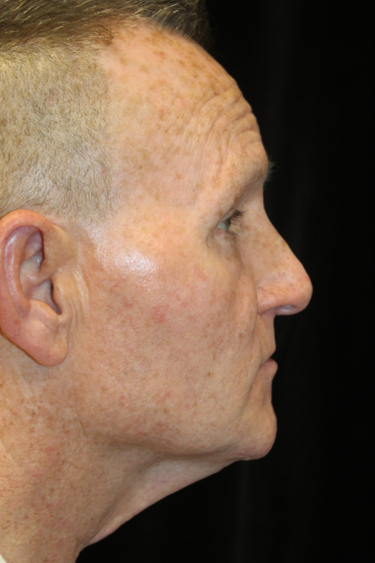 Before Image: Deep Plane Face & Neck Lift - right-side