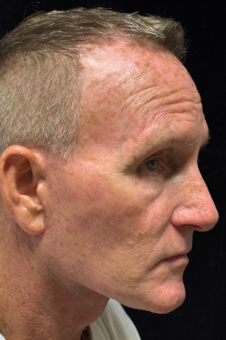 After Image: Deep Plane Face & Neck Lift - right-side