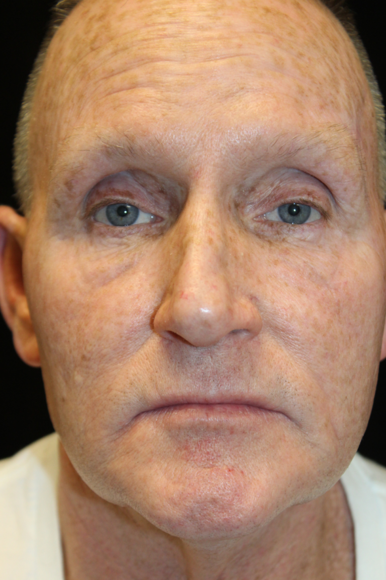 Before Image: Deep Plane Face & Neck Lift - front