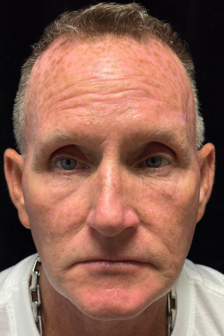After Image: Deep Plane Face & Neck Lift - front