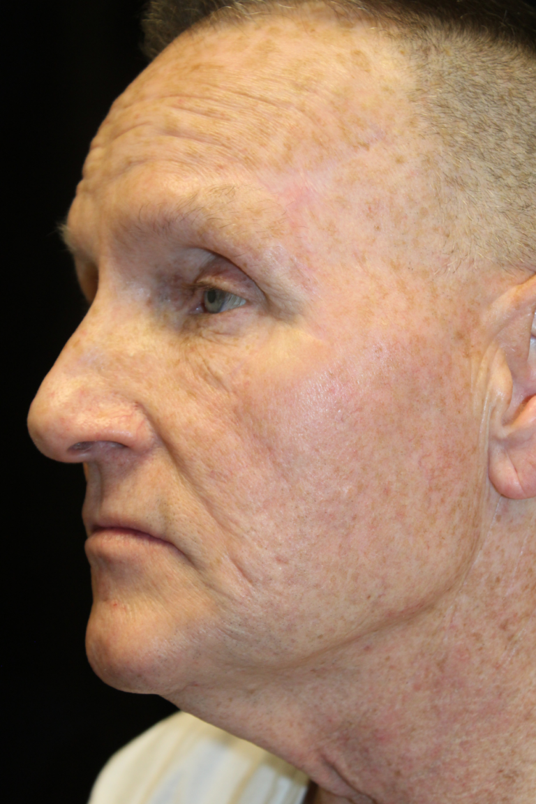Before Image: Deep Plane Face & Neck Lift - left-front-oblique