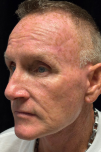After Image: Deep Plane Face & Neck Lift