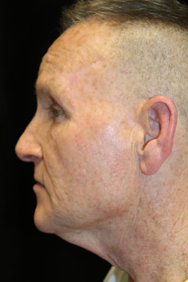 Before Image: Deep Plane Face & Neck Lift - left-side