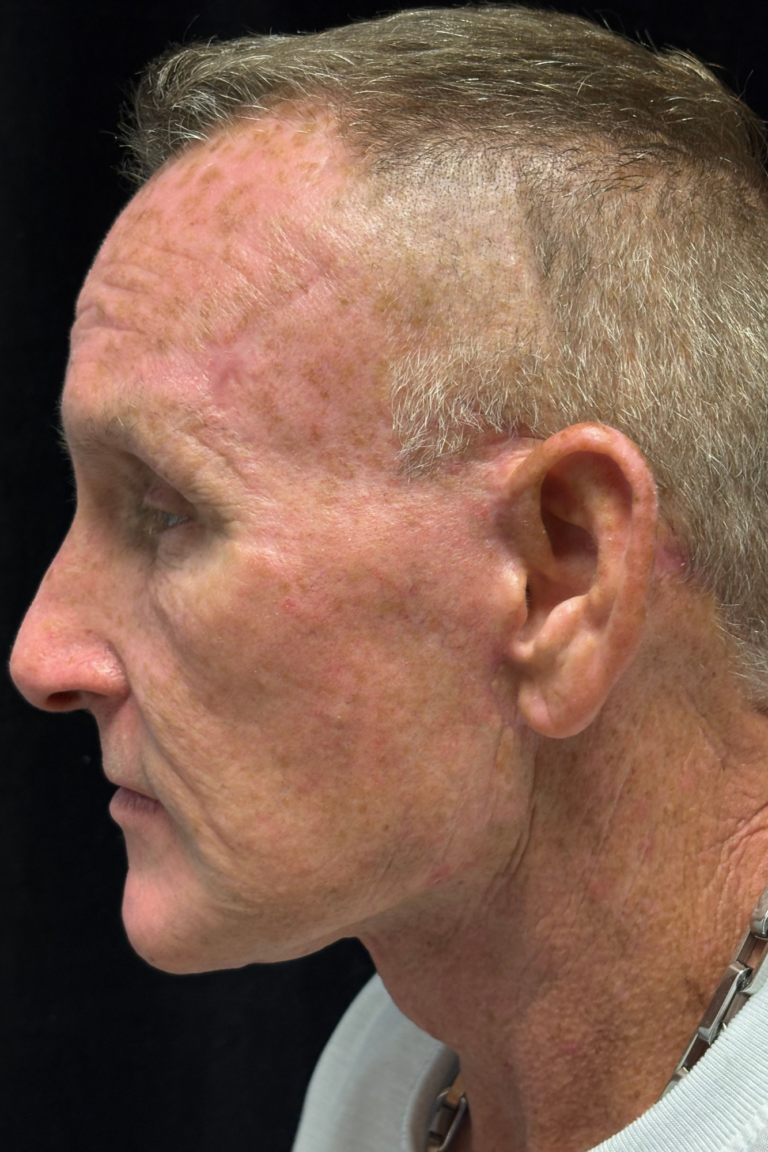 After Image: Deep Plane Face & Neck Lift - left-side