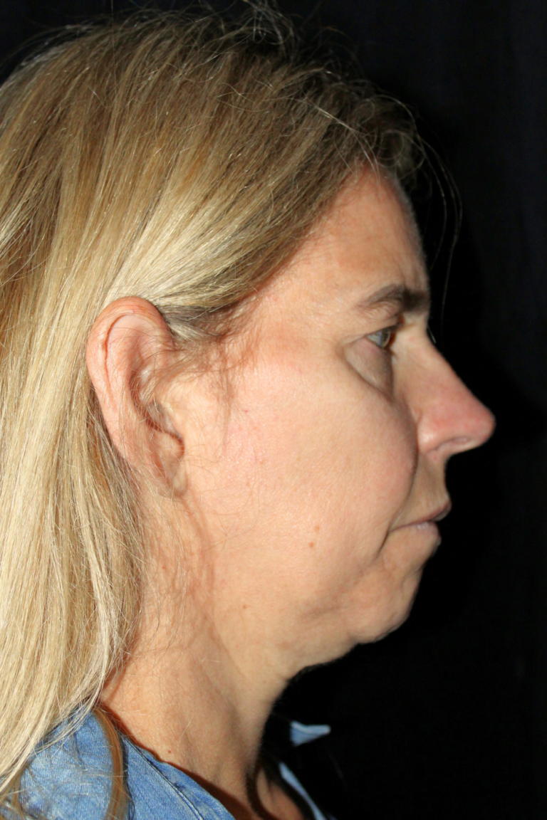 Before Image: Deep Plane Face & Neck Lift - right-side