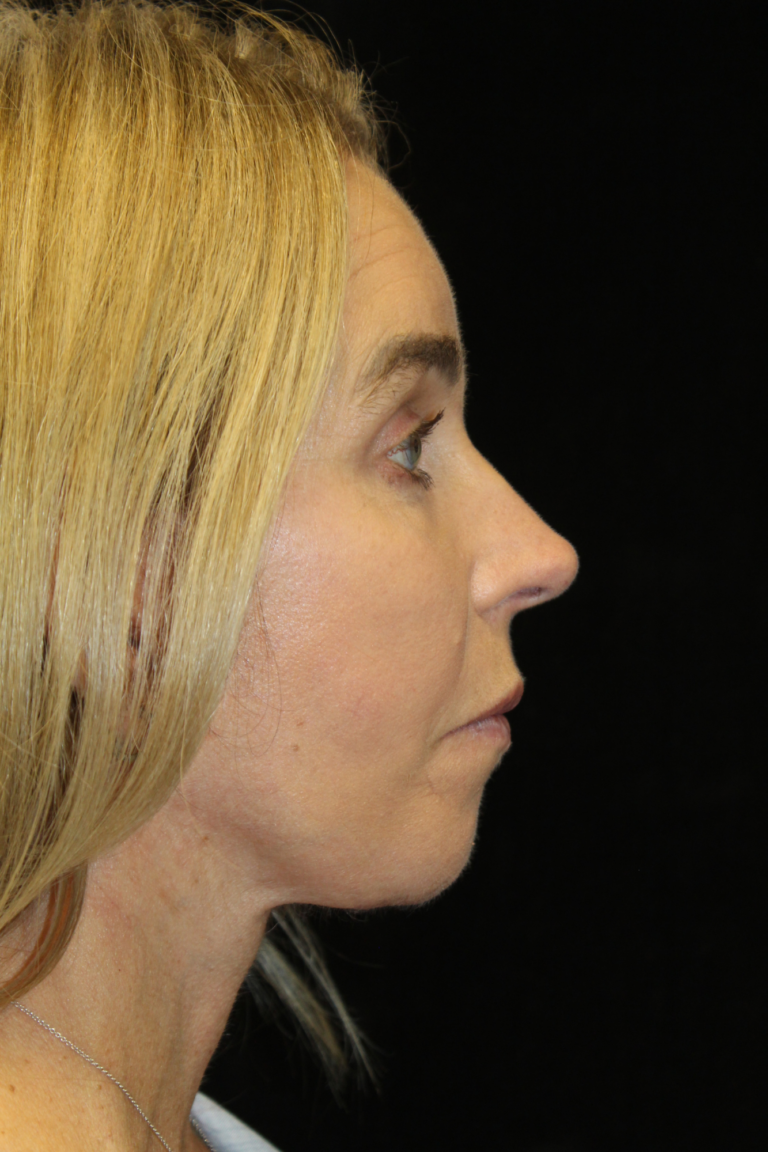 After Image: Deep Plane Face & Neck Lift - right-side