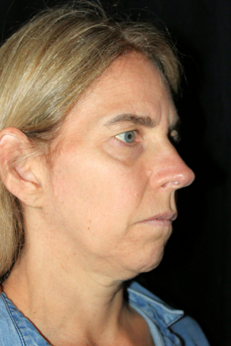 Before Image: Deep Plane Face & Neck Lift - right-front-oblique