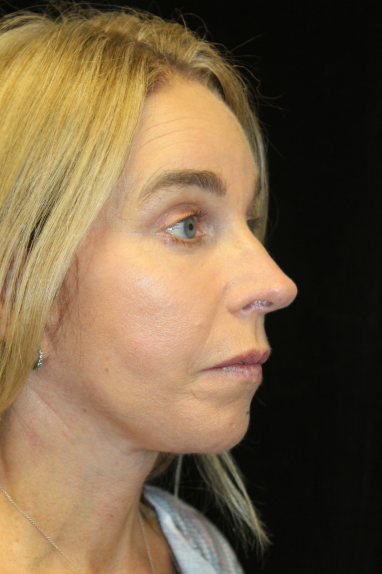 After Image: Deep Plane Face & Neck Lift - right-front-oblique