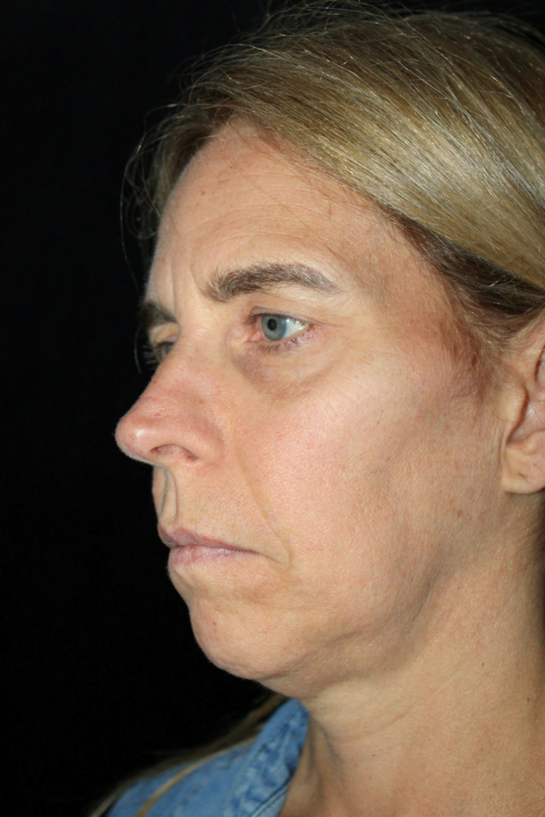 Before Image: Deep Plane Face & Neck Lift - left-front-oblique