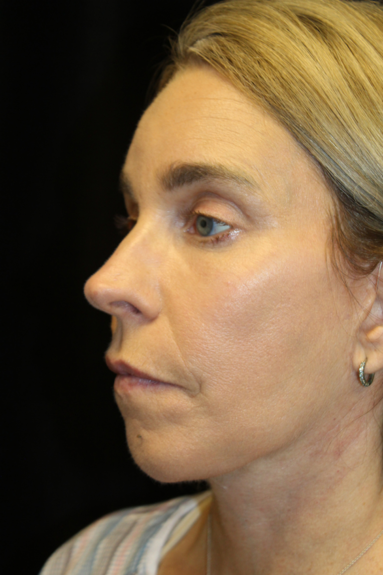 After Image: Deep Plane Face & Neck Lift - left-front-oblique