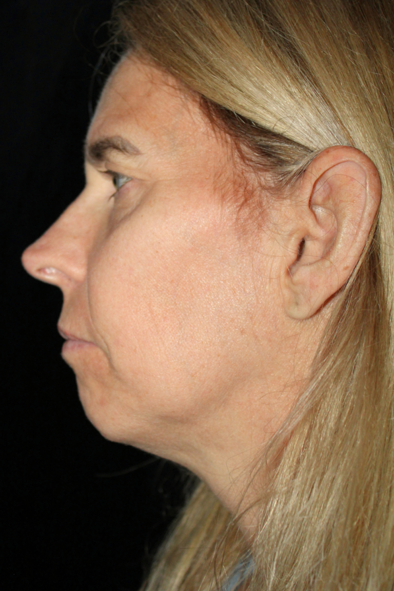 Before Image: Deep Plane Face & Neck Lift - left-side