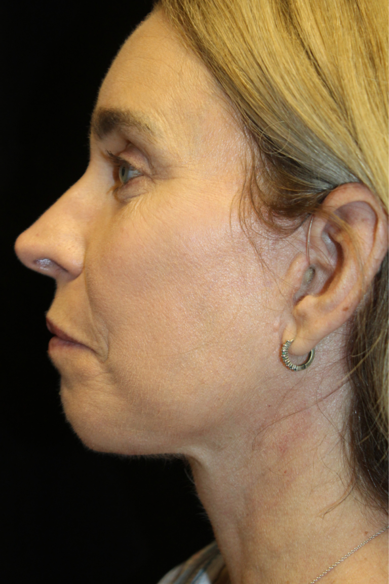 After Image: Deep Plane Face & Neck Lift - left-side