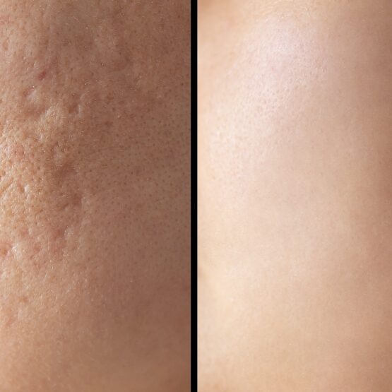 Acne Scar Treatment
